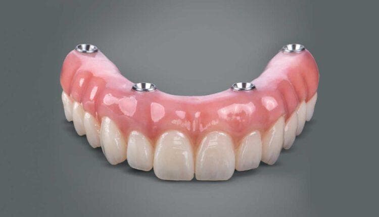How Painful is Getting a Dental Implant?