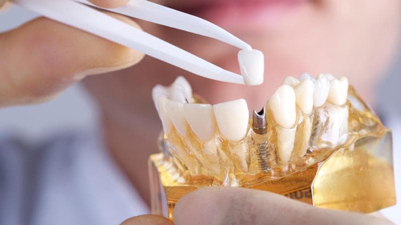 Affordable Dental Implants in Dallas: Quality Care by Atlantis Dental