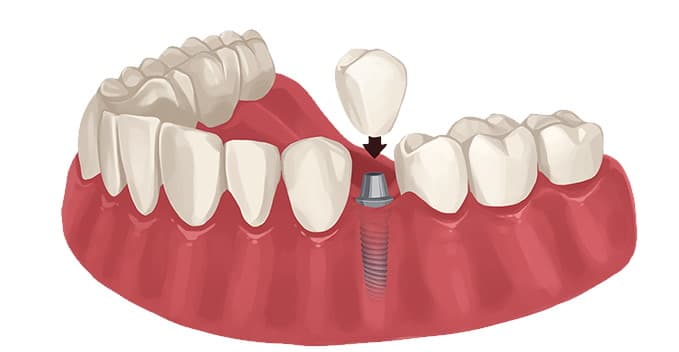 Emergency Same-Day Dental Implants