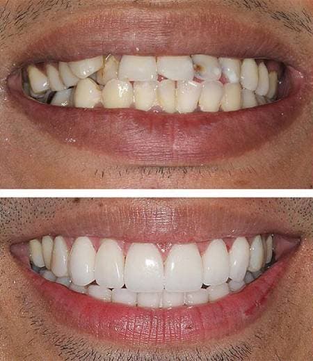 Teeth Before Veneers
