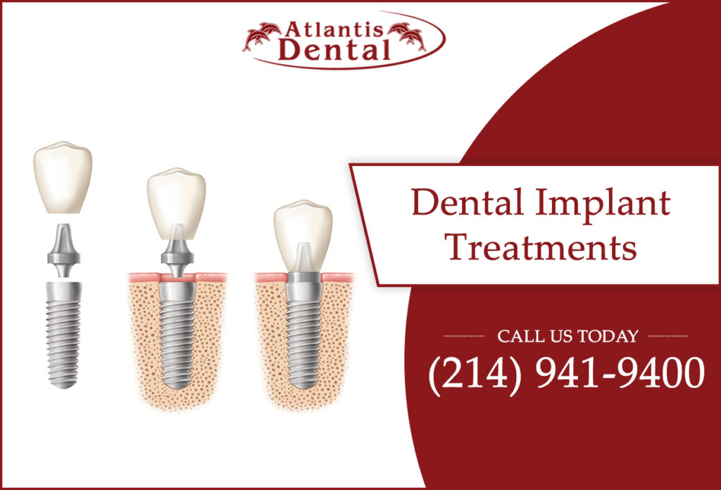 Dental Implant