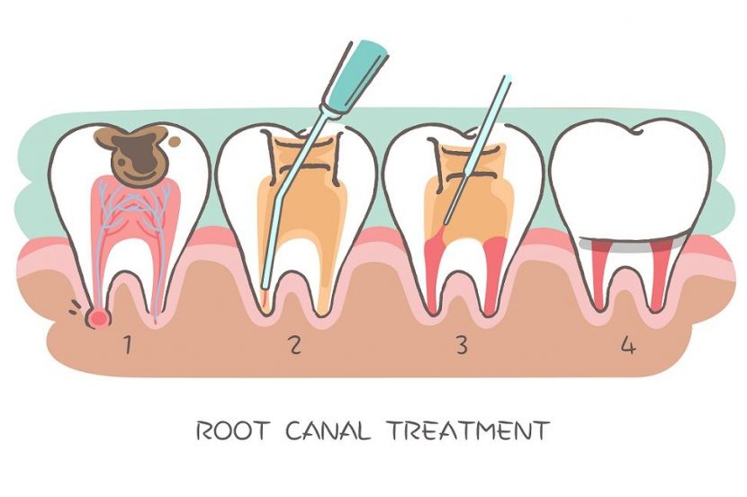 Root canal treatment