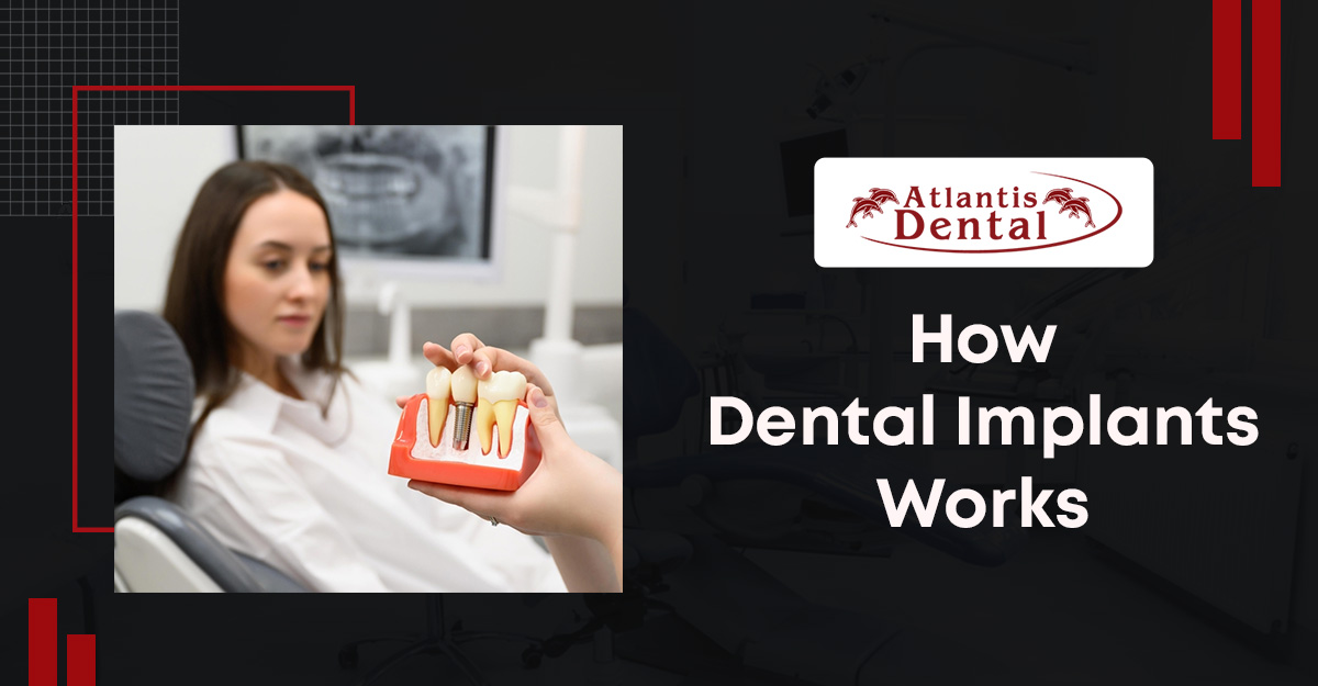 Dental Implants Works